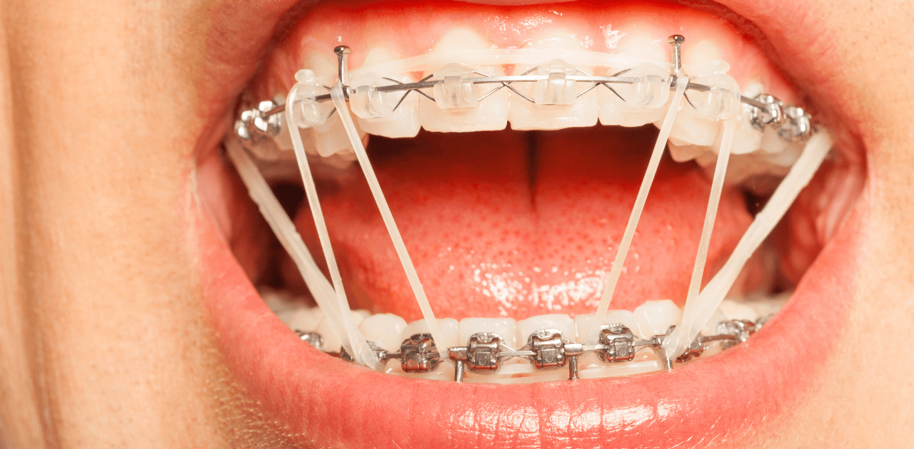 דוגמא לגשר בשיניים עם גומיות לשיניים עקומות
