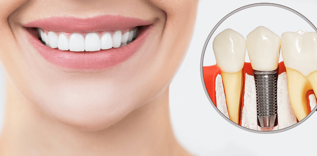 דוגמא להשתלת שיניים ליישור שיניים עקומות