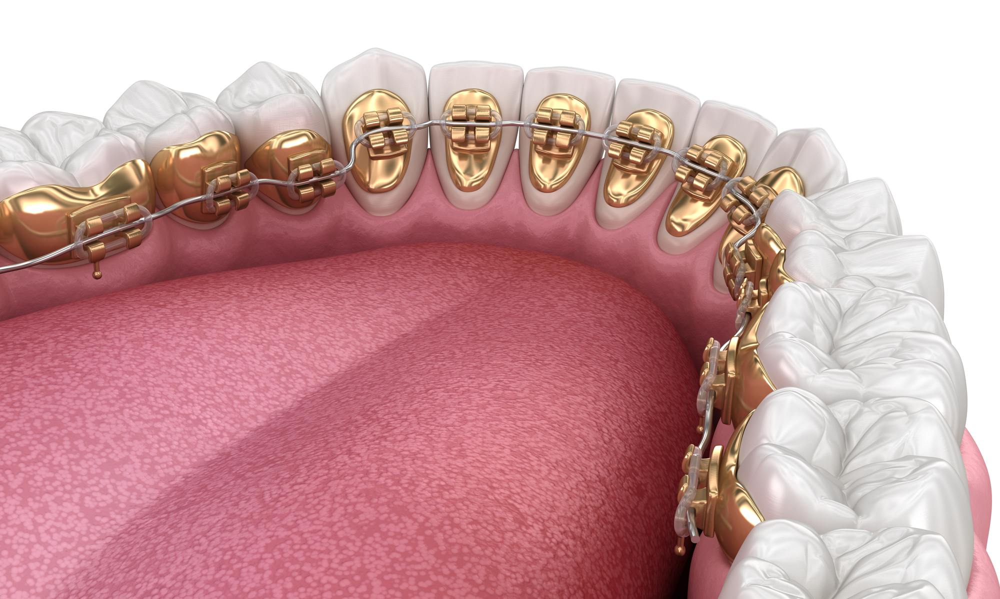 יישור שיניים פנימי - גשר המתוקן בחלק הפנימי של השיניים