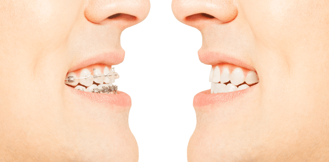 דוגמא לשיניים עקומות עם גשר בשיניים לעומת אחרי עם שיניים ישרות