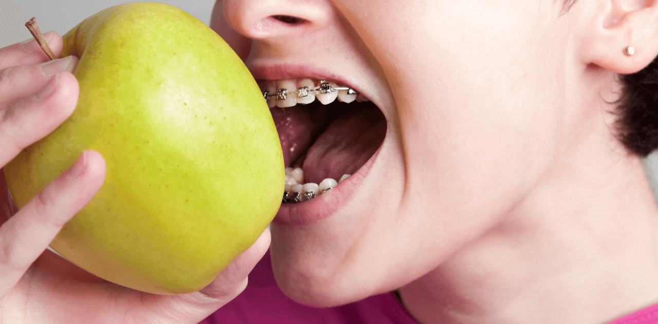 מה הקשר בין תזונה ליישור שיניים